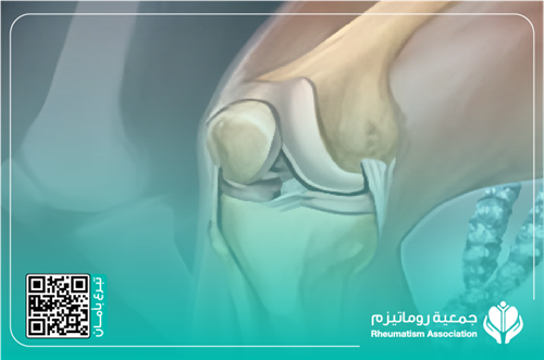 منيره، احتياج لتدخل جراحي عاجل – عملية تغيير مفصل 