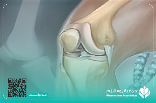مها، احتياج لتدخل جراحي عاجل – عملية تغيير مفصل الركبتين